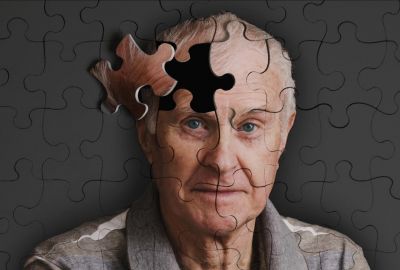 Pregnenolone - Tăng cường chức năng nhận thức ở bệnh nhân Alzheimer